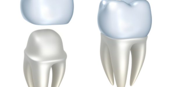 Couronne dentaire, les différences entre les couronnes céramo-métallique et les couronnes en zircone?