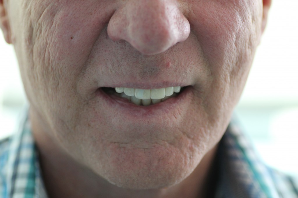 Couronnes dentaire : Avant - Après, résultats après la pose