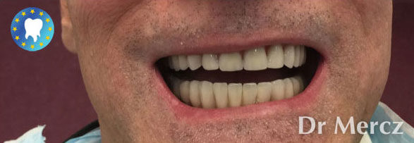 Résultat couronnes dentaires avec bridge sur implants