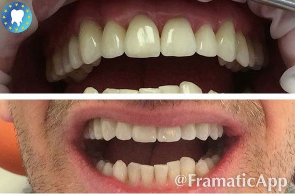 Résultats couronnes dentaires en zircone