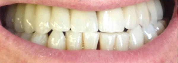Résultats implants dentaires plus couronnes dentaires