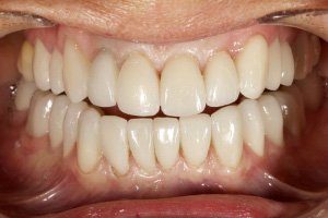 Résultat avant après couronnes dentaires zircone et facette Emax