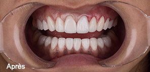 Résultat soins dentaires Izmir