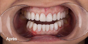 Résultat facettes dentaires Emax à Izmir