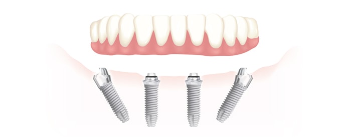 Implants dentaires mâchoire complète - Turquie, Dentiste